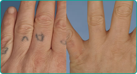 Before and after laser treatment for tattoo removal